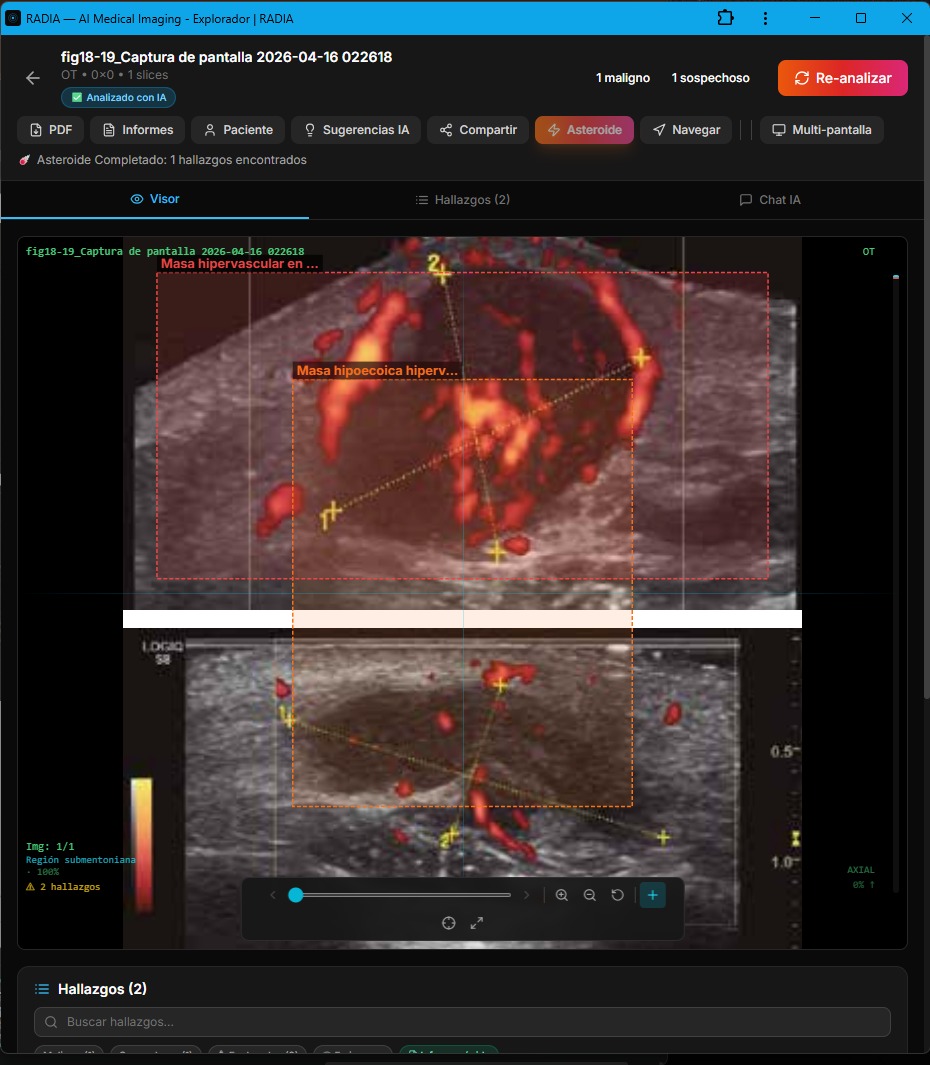 Color Doppler ultrasound in RADIA: two views of superficial hypervascular mass, labeled bounding boxes Masa hipervascular and Masa hipoecoica hiperv...