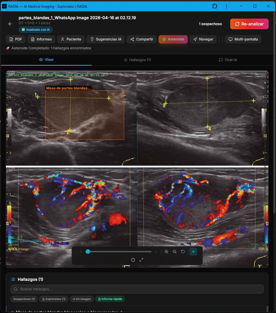 RADIA analyzing soft tissue ultrasound: B-mode above showing hypoechoic mass with bounding box, color Doppler below revealing intense hypervascularization