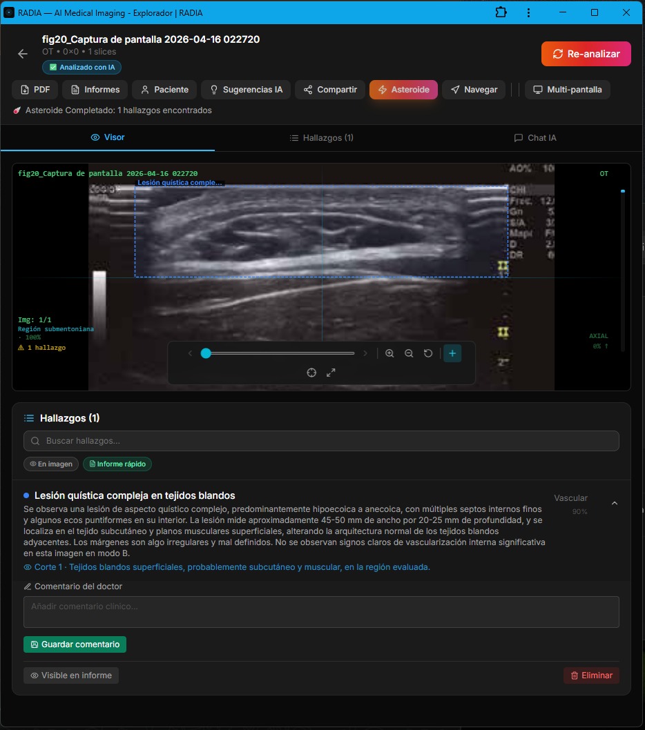 RADIA showing complex cystic lesion on ultrasound: cyan bounding box over multiseptated lesion in subcutaneous tissue, finding classified as Vascular 90% with doctor comment field visible