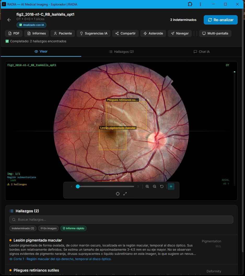 RADIA analyzing fundus photograph with pigmented macular lesion: yellow bounding box over an oval dark brown lesion in the macula, classified as Pigmentation 95%