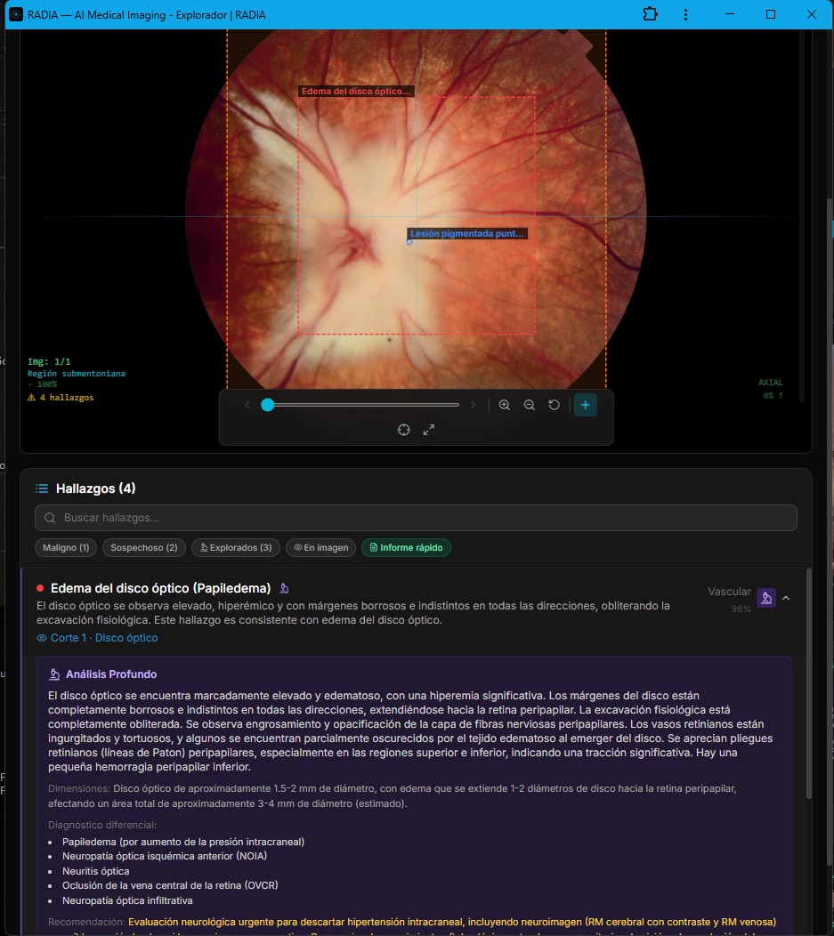 Deep Analysis of papilledema in RADIA: detailed description with dimensions, clinical differential (papilledema, NAION, optic neuritis, CRVO) and urgent neuroimaging recommendation