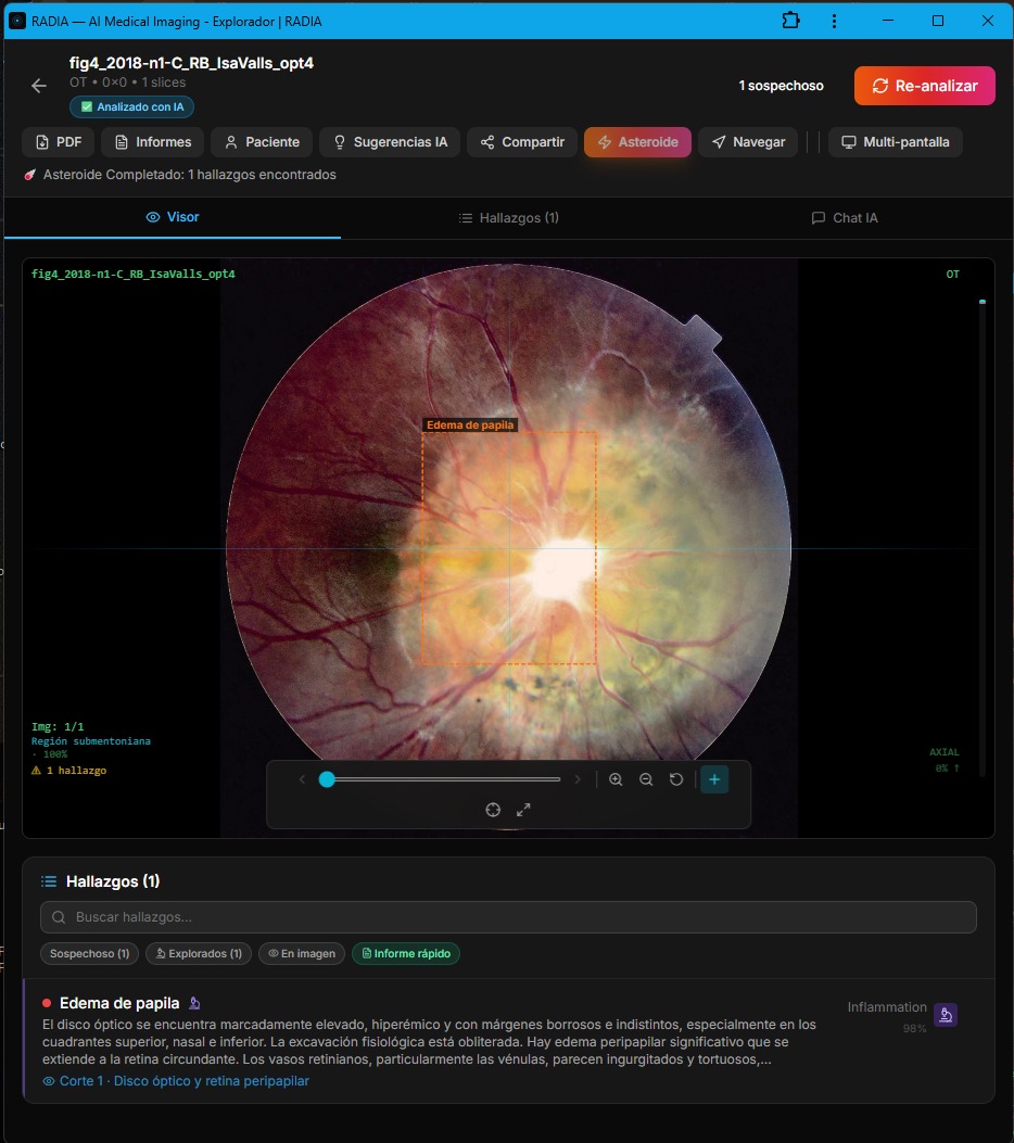 RADIA detecting papilledema in fundus photograph: markedly elevated optic disc with blurred margins, bounding box labeled Edema de papila - Inflammation 98%