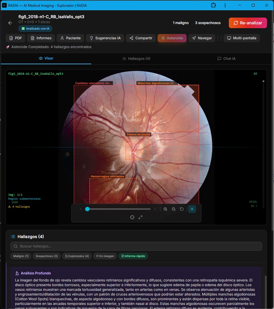 RADIA analyzing severe ischemic retinopathy: 4 findings detected - retinal vascular changes, cotton wool spots, papilledema and hemorrhages with bounding boxes and visible deep analysis
